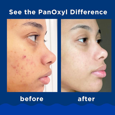 PanOxyl Acne Creamy Wash Benzoyl Peroxide 4% Daily Control - MeStore - PanOxyl